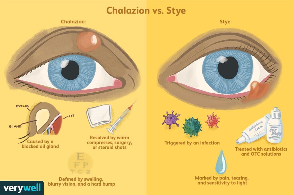 5 Simple Steps To Prevent Stye Contagion