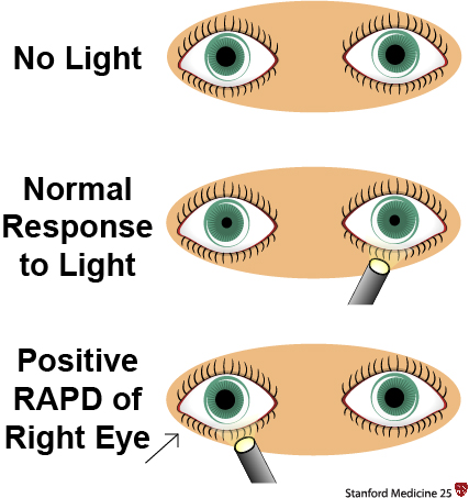 Afferent Pupillary Defect