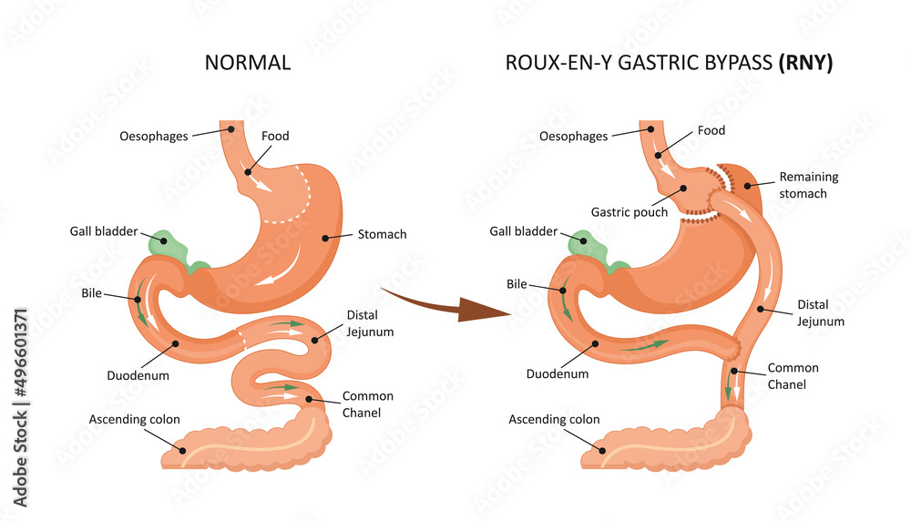 Gastric Bypass Showing Short Vertical Lesser Curve Based Gastric Pouch