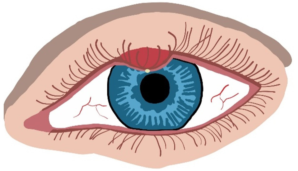 Hordeolum Vs Chalazion