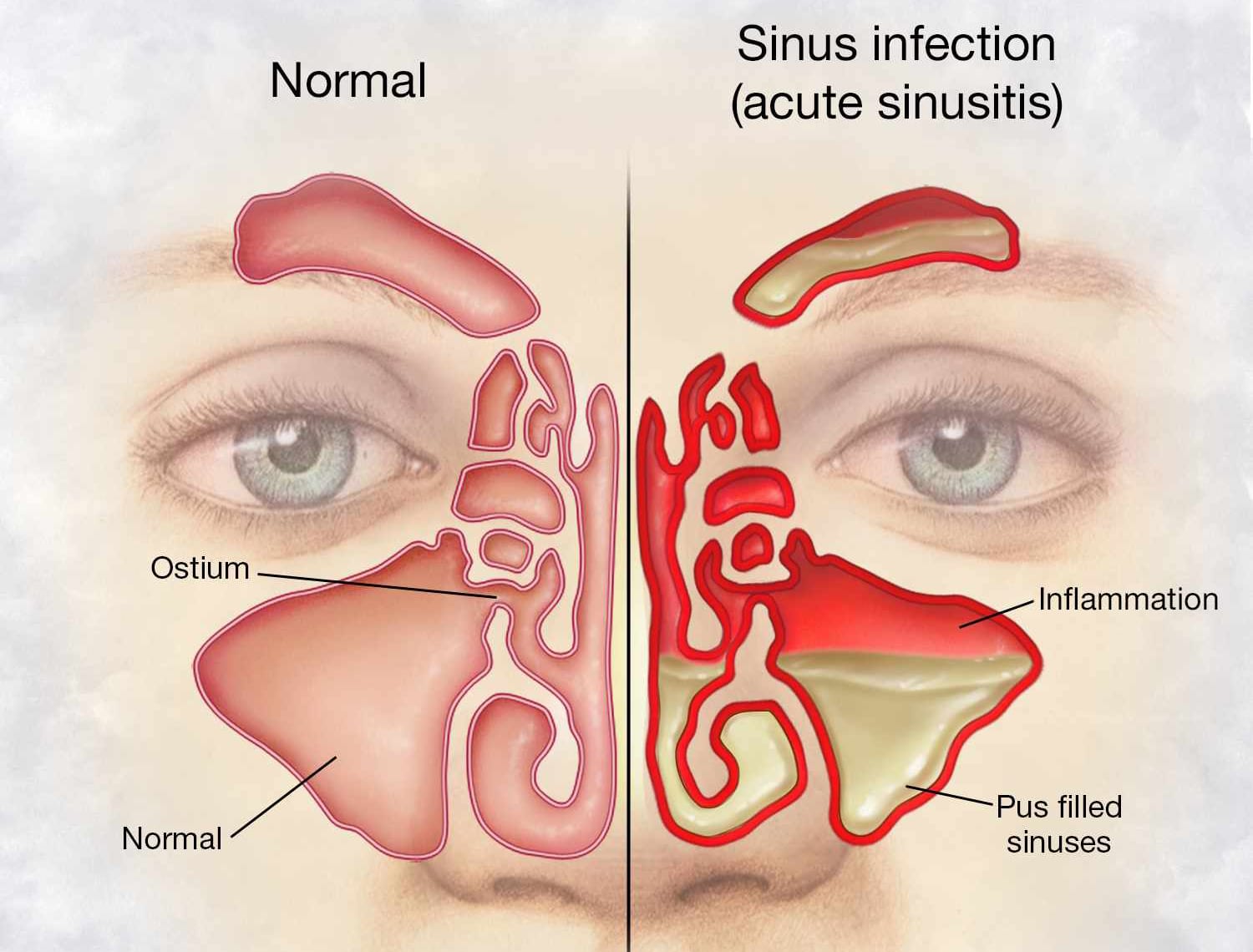 How To Relieve Your Sinus Infection In Under 30 Seconds Sinus