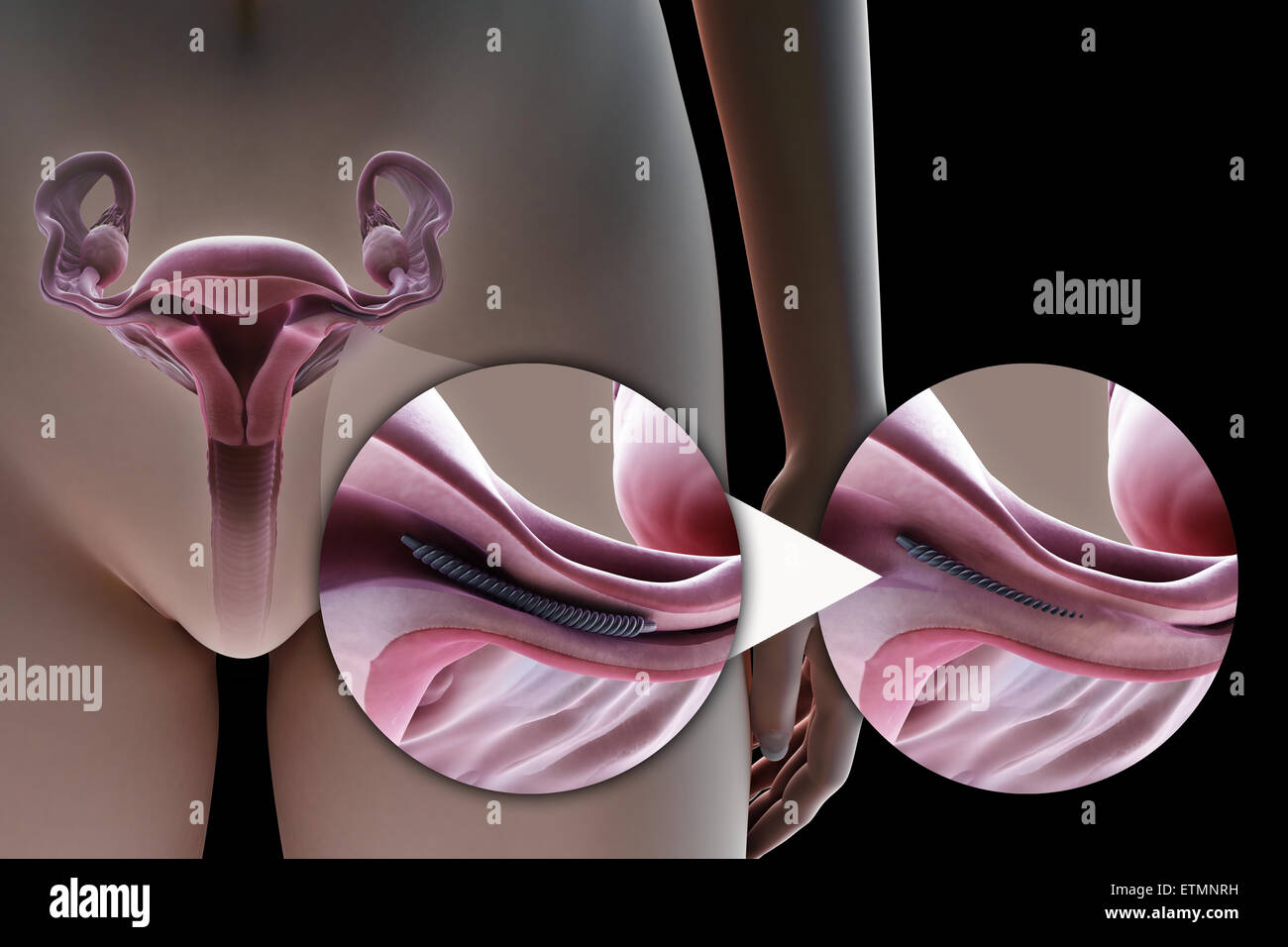 Illustration Showing Tubal Ligation Of The Fallopian Tube By Method Of