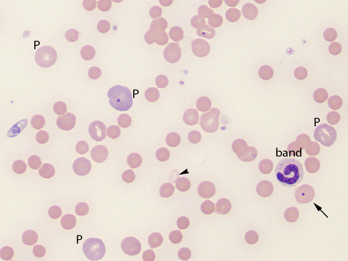 Immune Mediated Hemolytic Anemia