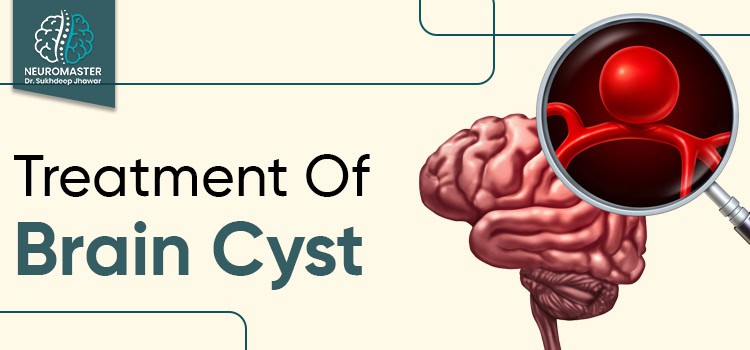 Know In Detail About Brain Cyst Treatment For Better Health