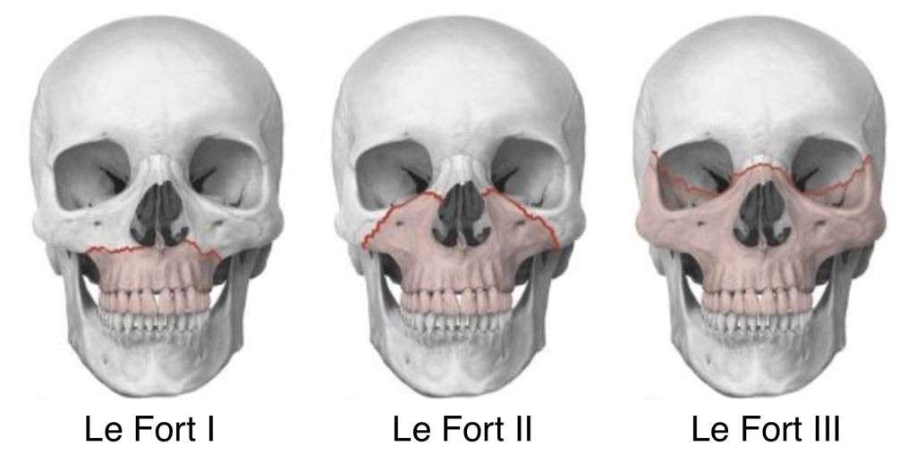 Le Fort Fracture