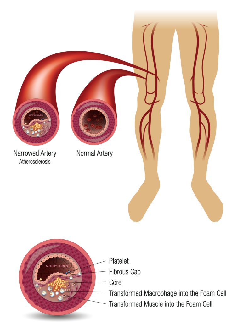 Pvr Peripheral Vascular Disease In Medical Science By