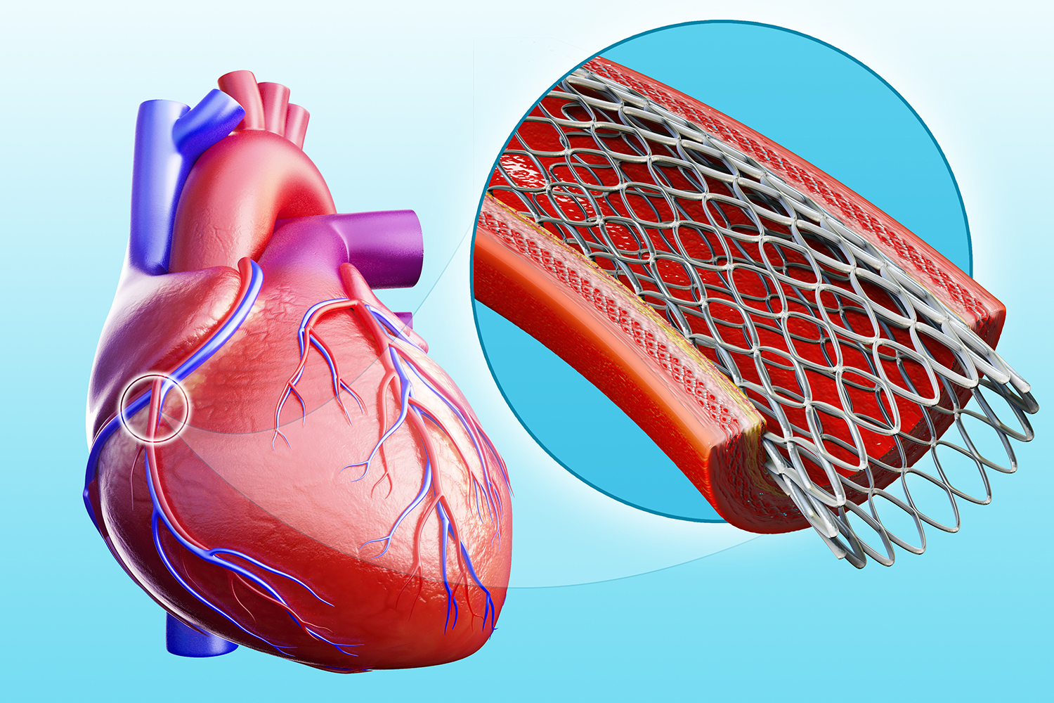 Risk Of Death During Stent Procedure