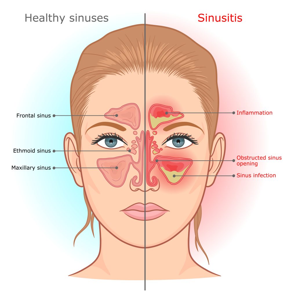 Sinus Infection Warning Signs And Symptoms When To See A Doctor For