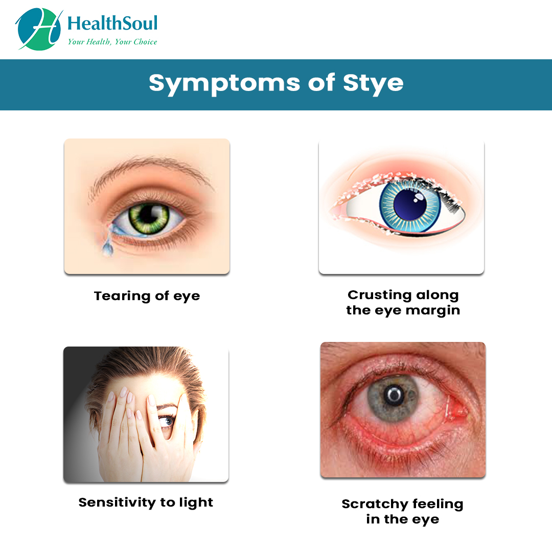 Stye Pictures Contagious Symptoms Causes Treatment