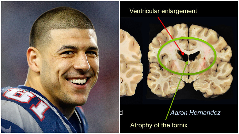 The Cte Truth: Aaron Hernandez's Neurological Battle Unveiled