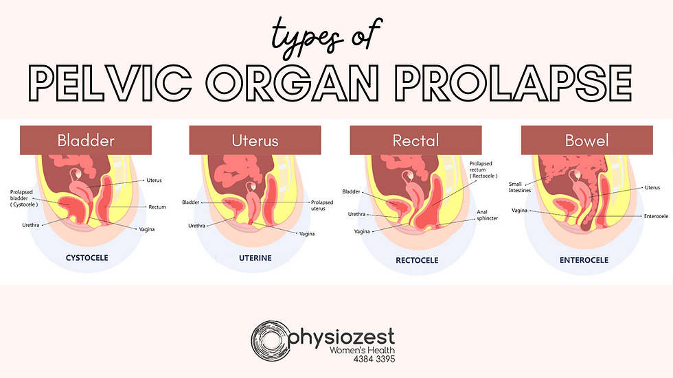 Using A Pessary: Find Relief From Symptoms Fast