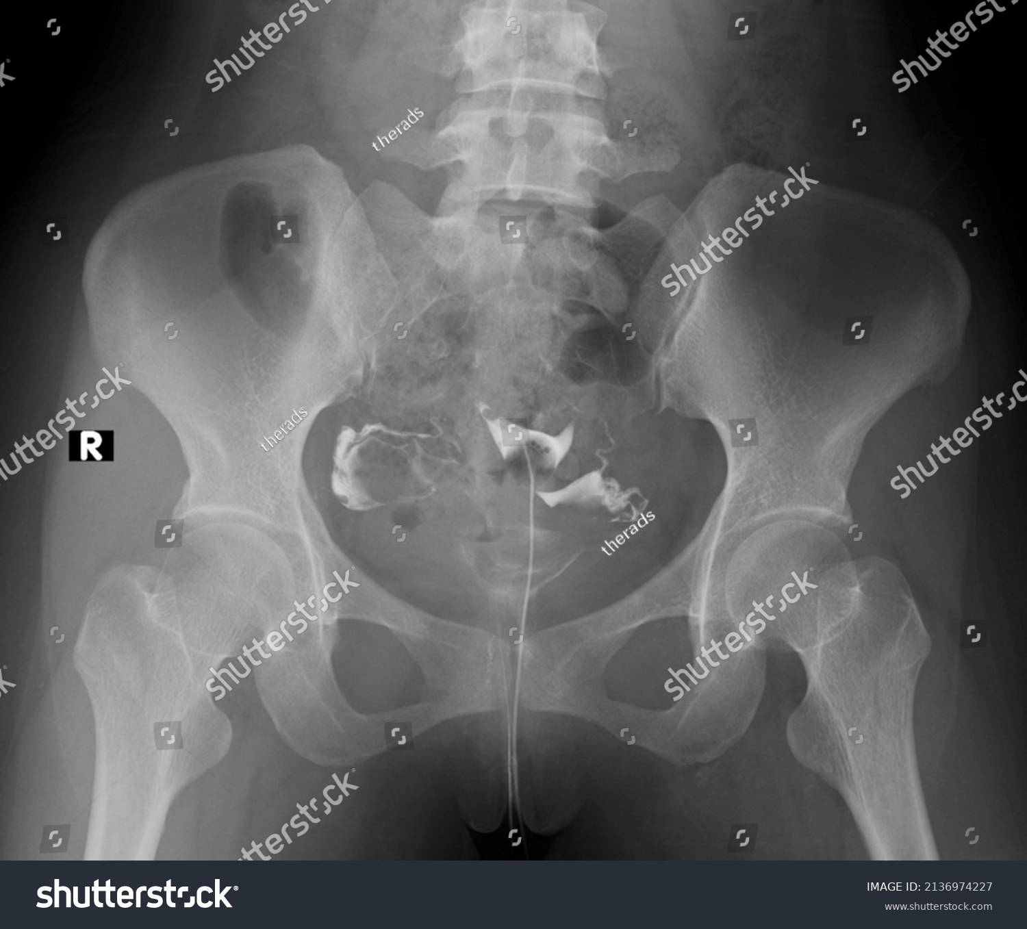 Uterus X Ray Over 280 Royalty Free Licensable Stock Photos Shutterstock