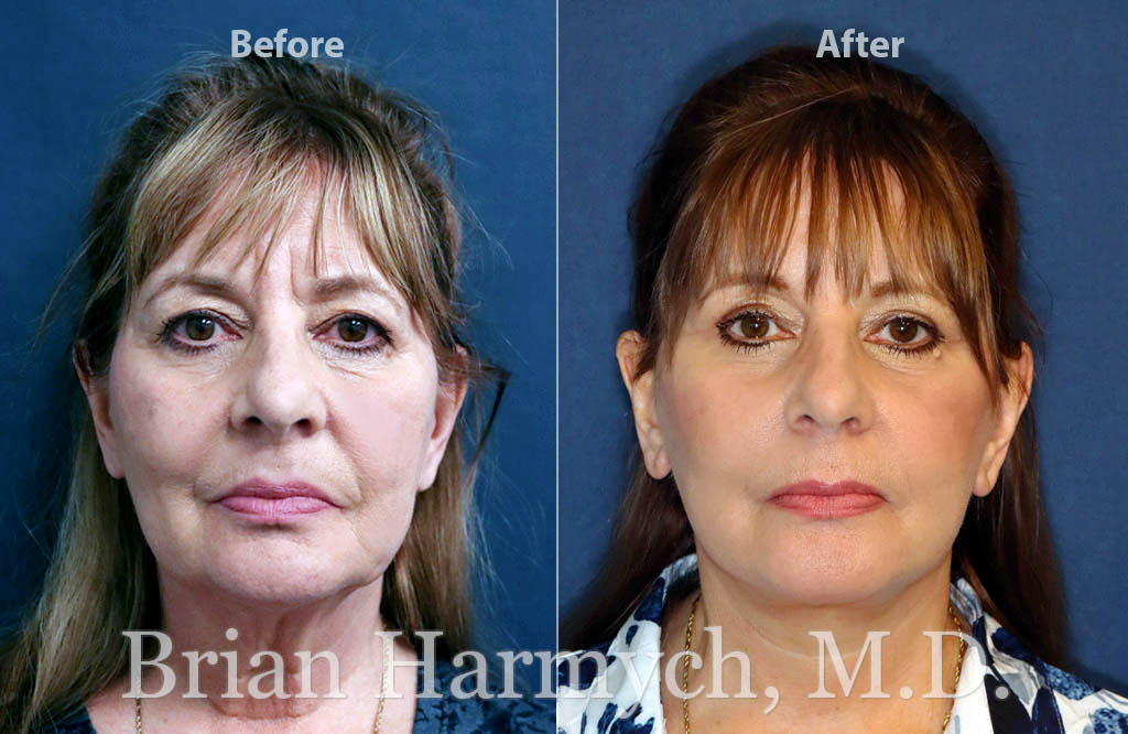 What S A Deep Plane Facelift Dr Duplechain Cosmetic Plastic